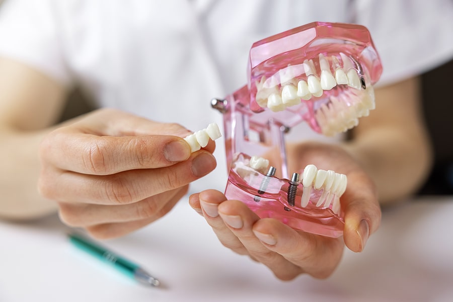 Your Guide to a Fixed Bridge Dental Procedure